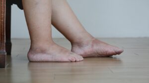 Edema / Pés Inchados 1
